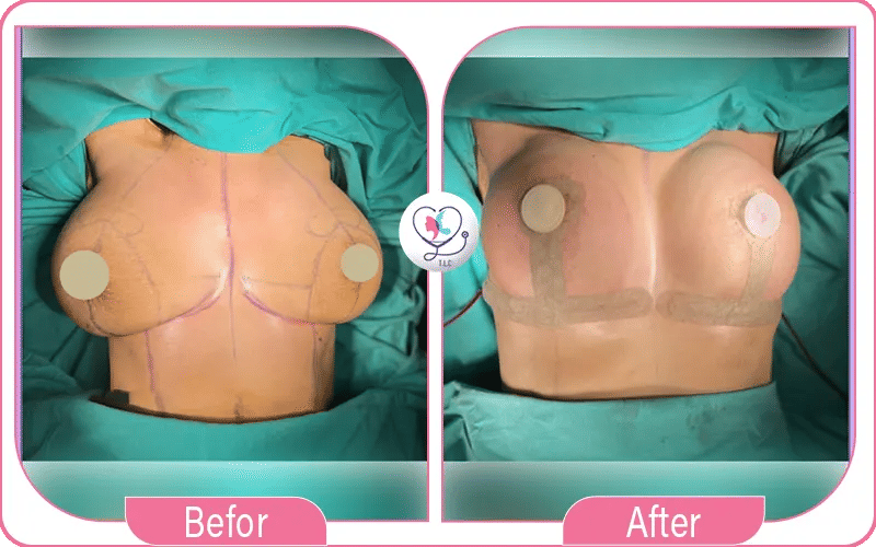 Résultats d’une chirurgie pour remonter la poitrine-2