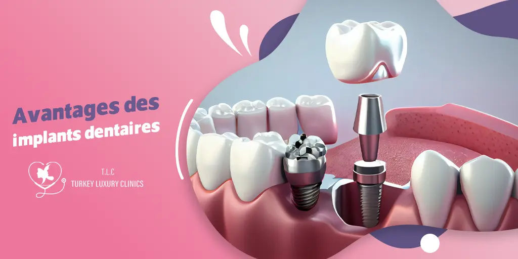 Avantages des implants dentaires