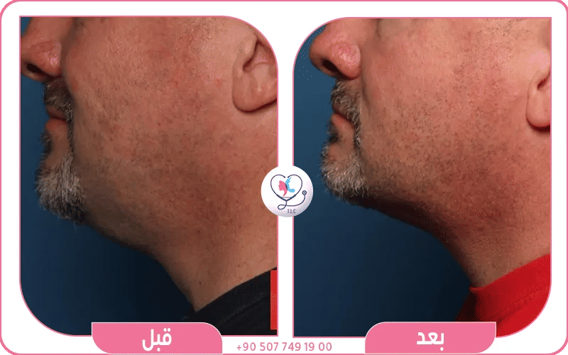 شفط دهون الوجه للرجال