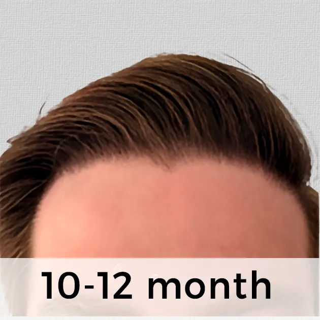 10–12 Months After Hair Transplant (40 48 Weeks)
