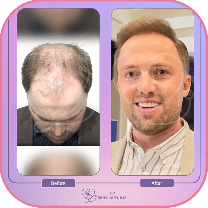 DHI Hair Transplant Turkey 2025: Prices, Results & What to Expect 