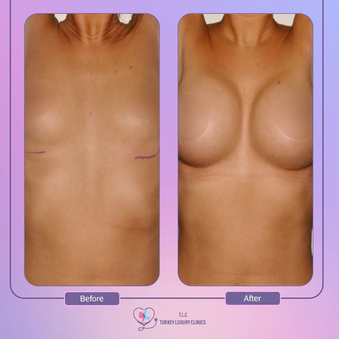 مزايا إجراء تكبير الثدي لدى تركيا لاكشري كلنيك