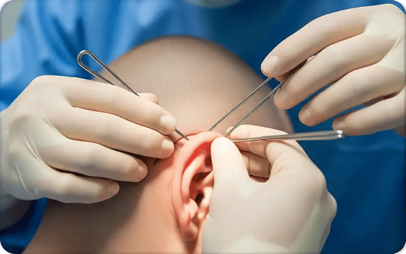 What is Otoplasty Plastic Surgery?