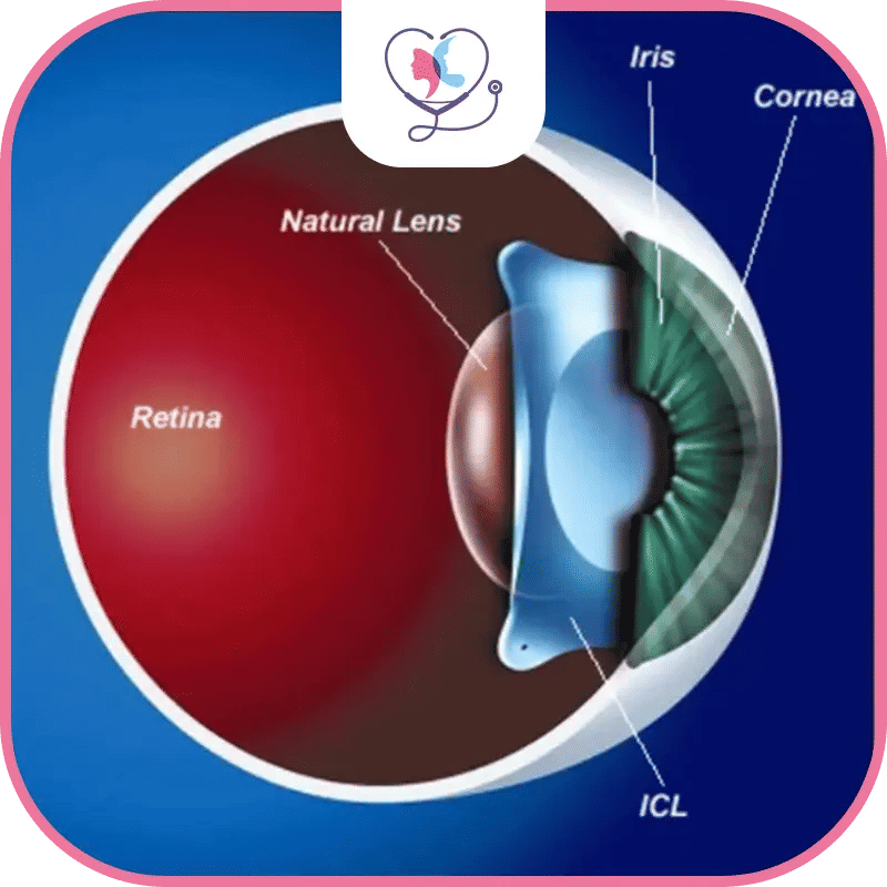 تكلفة زراعة العدسة الذكية في مختلف الدول