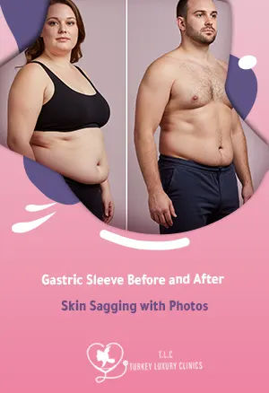 Gastric Sleeve Before and After Skin Sagging with Photos