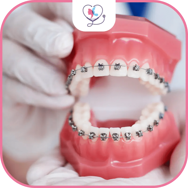 ما هو تقويم الأسنان؟