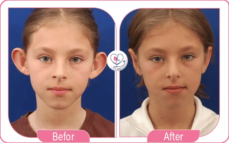 Book Your Otoplasty Consultation Today with Turkey Luxury Clinics