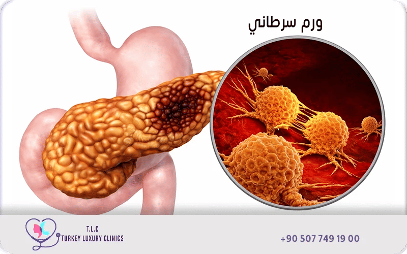 اعراض سرطان البنكرياس