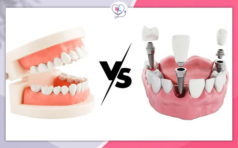 Dental Implants vs Dentures for Diabetics