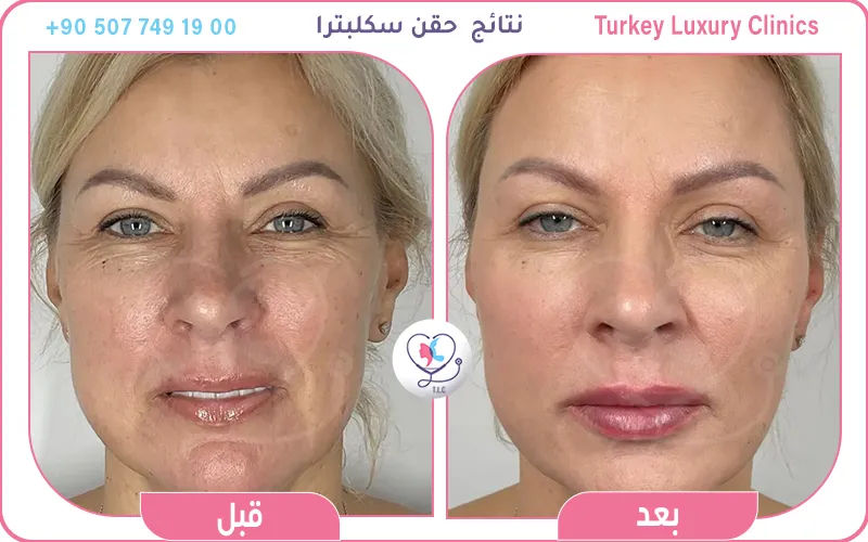 حقن سكلبترا