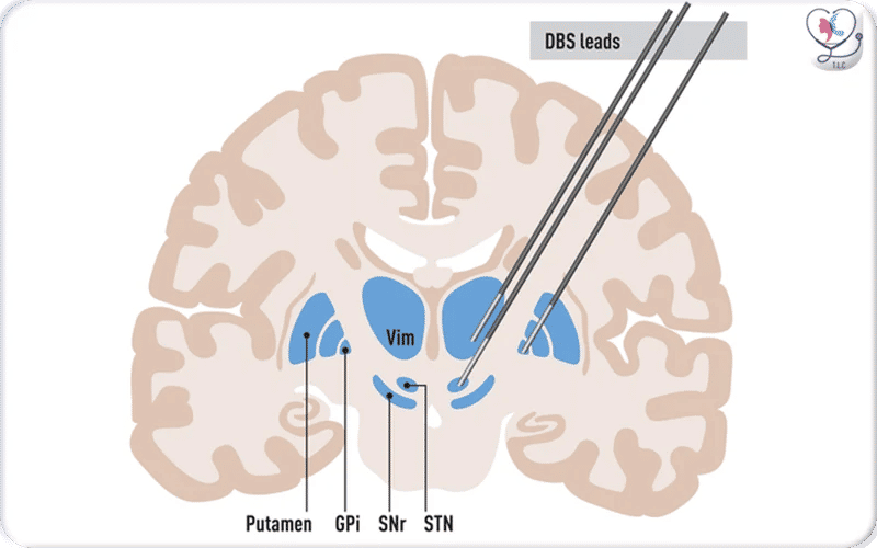 1. Determination site of Lead placement