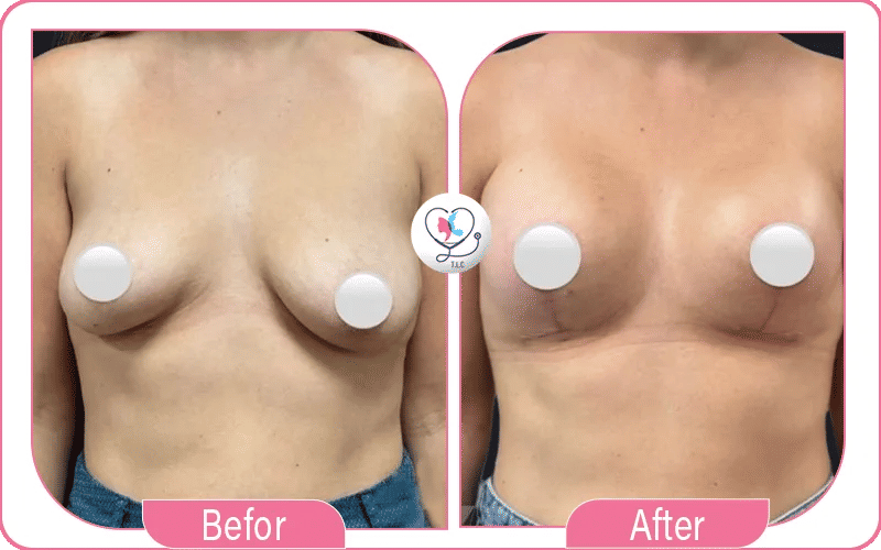 نصائح هامة من تجربتي مع سيليكون الثدي