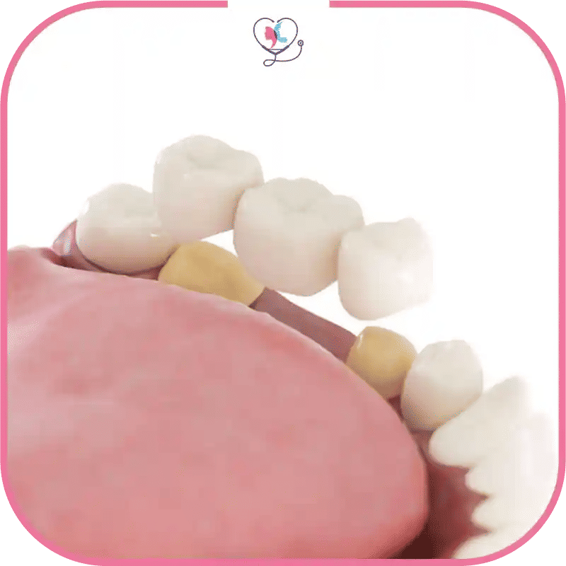 Symptômes des allergies aux implants dentaires