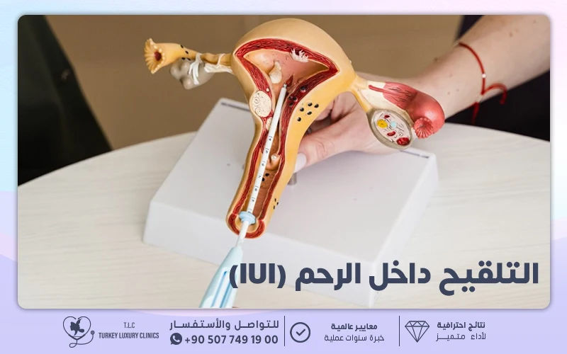 التلقيح داخل الرحم (IUI) التلقيح داخل الرحم (IUI)