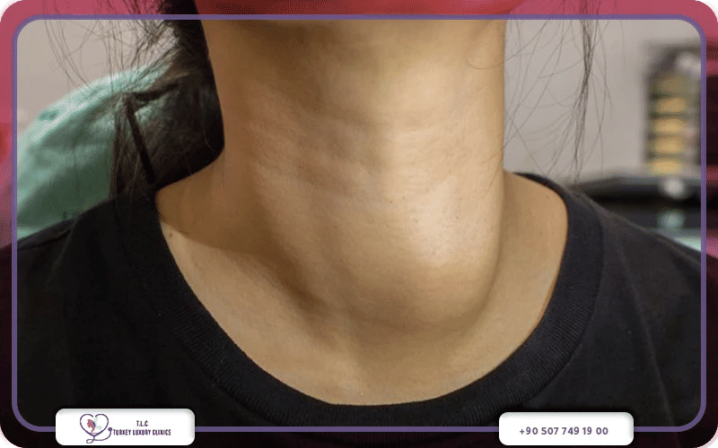 أعراض فرط نشاط الغدة الدرقية عند النساء