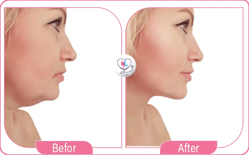 شفط اللغلوغ مع تركيا لاكشري كلينك