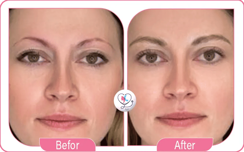 Eyebrow Transplant Results