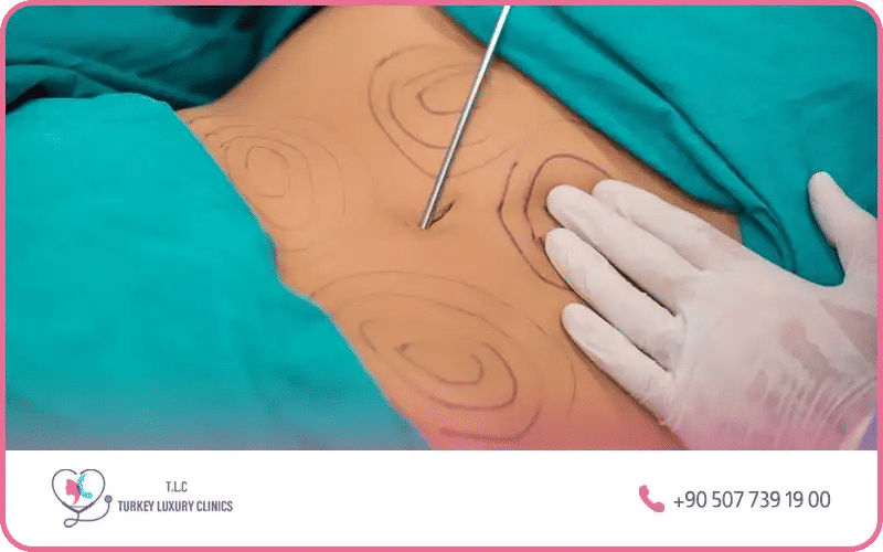 Abdominoplastie liposuccion ventre ratée