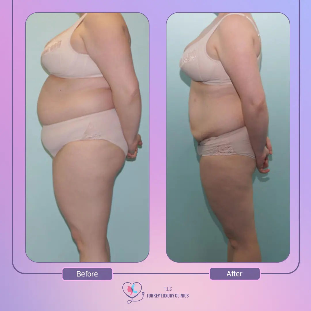 أسعار عملية تحويل المسار المصغر في تركيا لاكشري كلينك