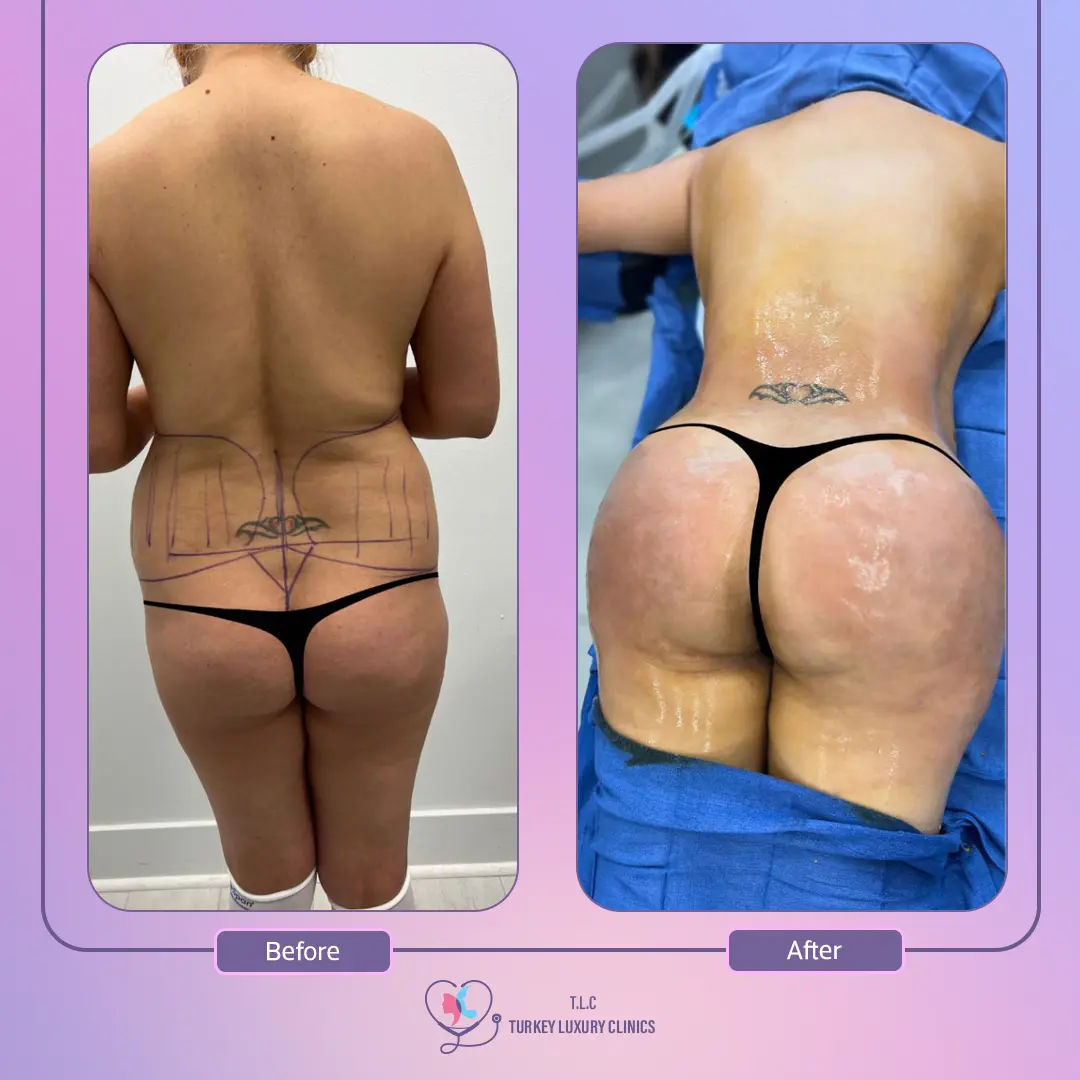 مزايا إجراء عملية شد ورفع المؤخرة لدى تركيا لاكشري كلنيك
