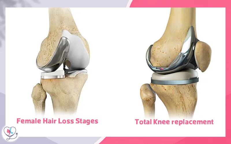Revision Knee Replacement
