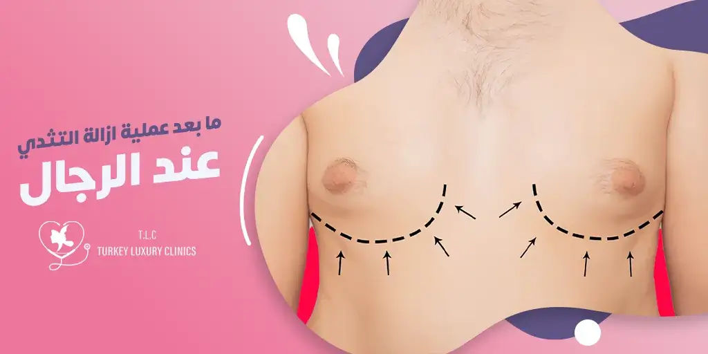 ما بعد عملية ازالة التثدي عند الرجال