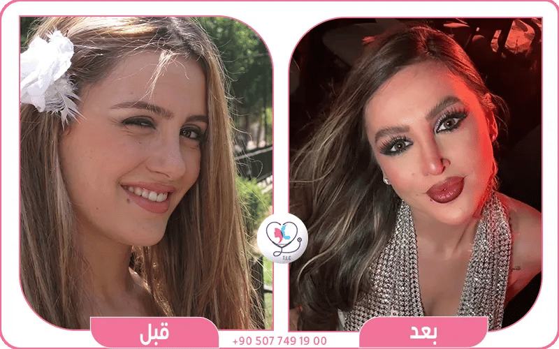 مرام علي قبل وبعد تجميل الأنف