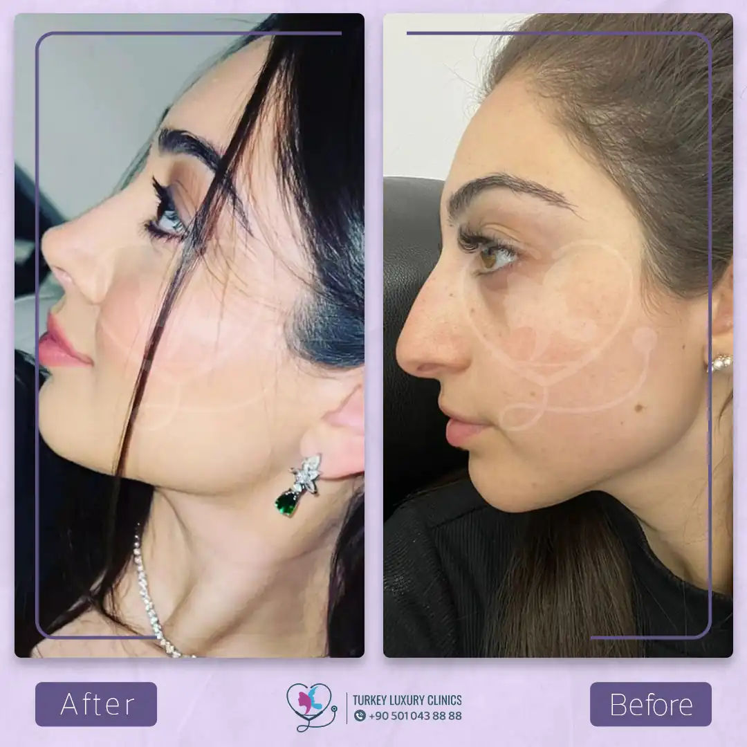 تجميل الأنف بدون جراحة بالخيوط