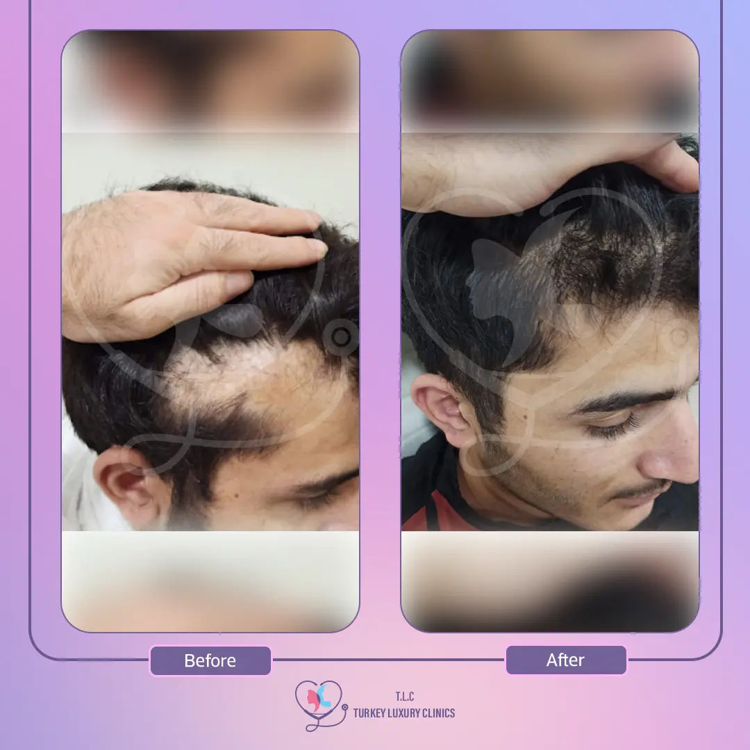 تساقط الشعر بعد عملية تكميم المعدة: الأسباب والوقاية والعلاج