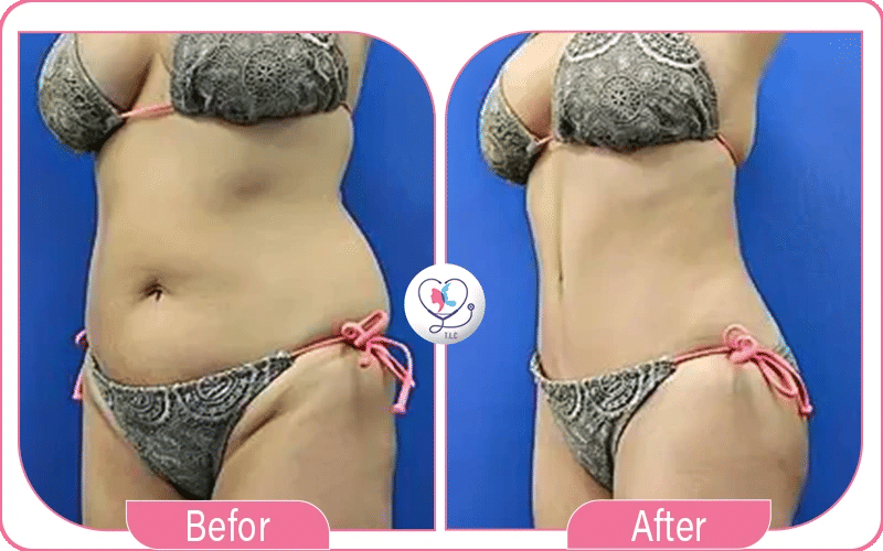 Tummy Tuck