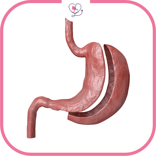 الفرق بين تكميم المعدة وبوتكس المعدة من حيث خطوات العملية