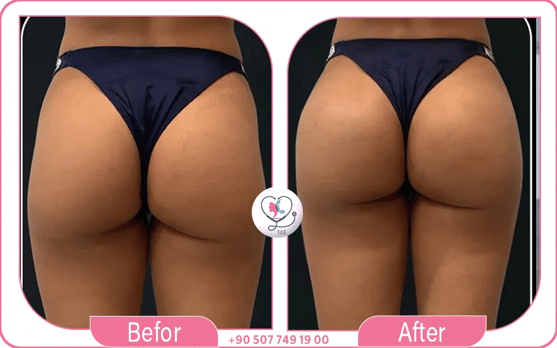 فيلر المؤخرة قبل وبعد