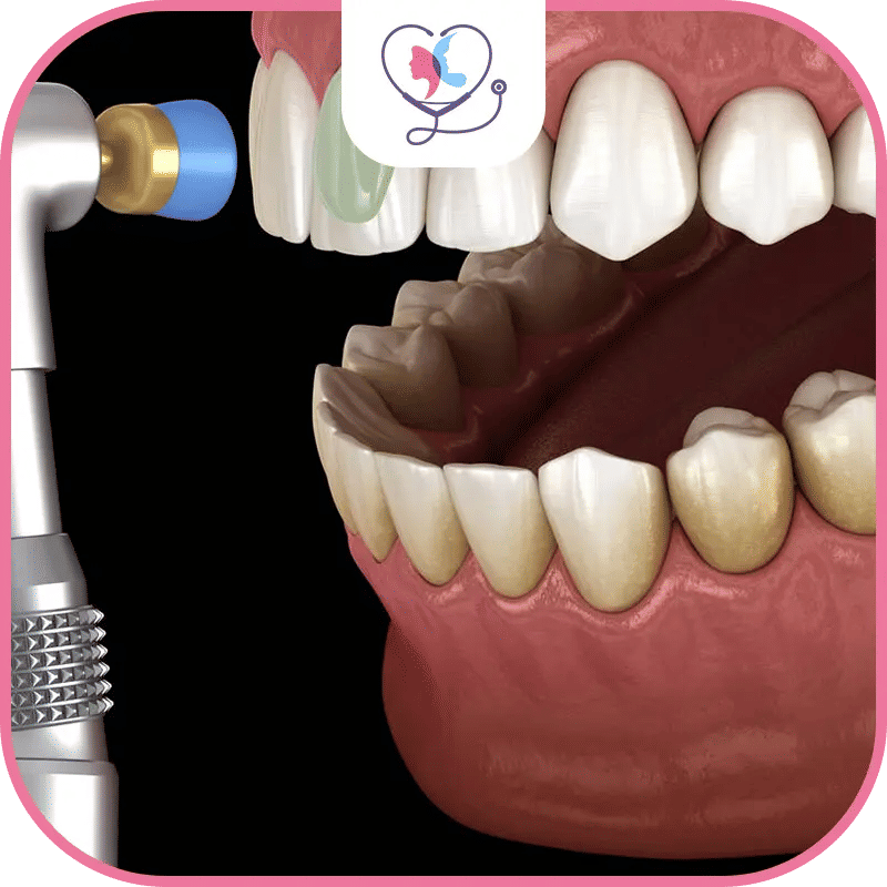 سادساً تنظيف الأسنان بالليزر