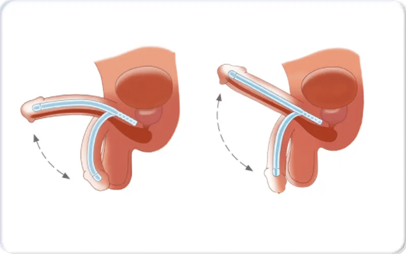 نصائح للحفاظ على فعالية الدعامة المرنة