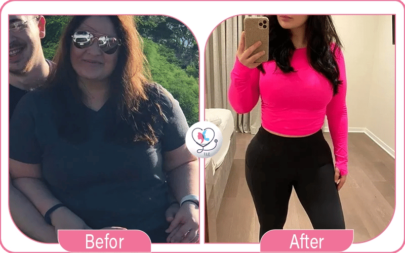 تجربتي مع تكميم المعدة: هل حقاً ندمت على العملية؟-1772048969077