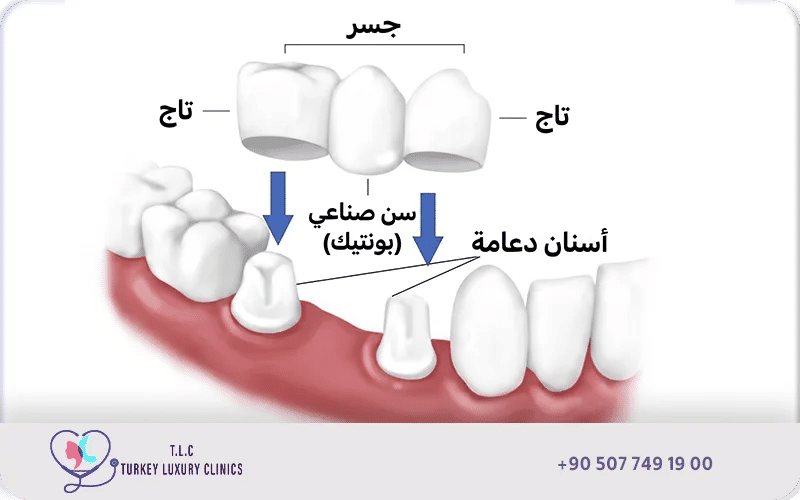 أسباب اختياري جسر الأسنان