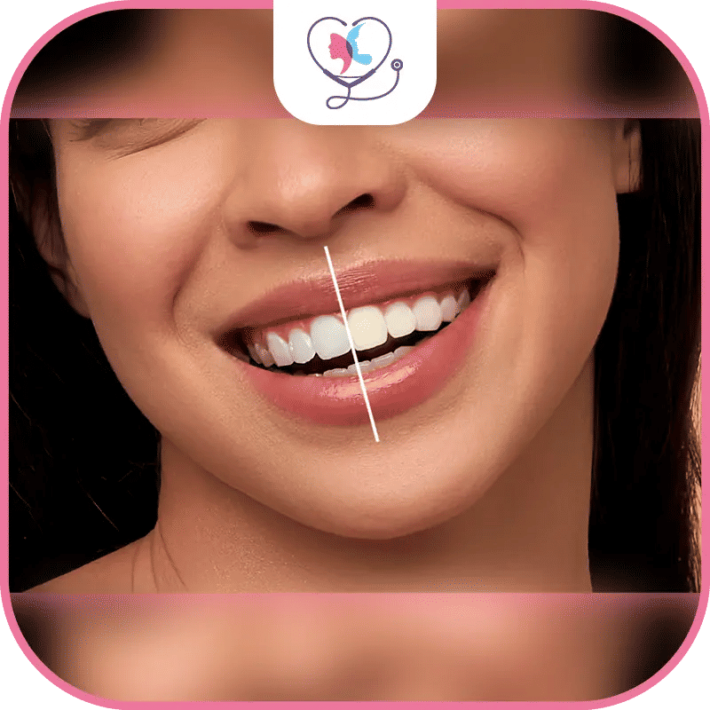 أسعار تنظيف الأسنان حسب الدول