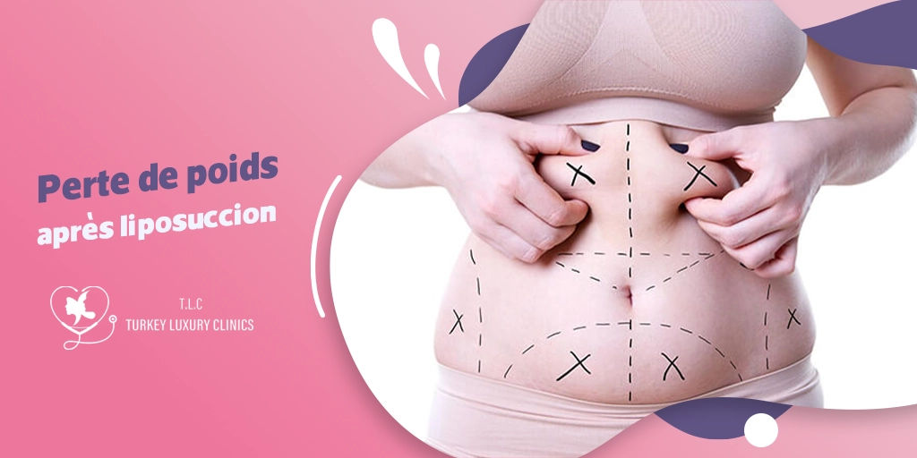 Perte de poids après liposuccion : Ce qu'il faut savoir