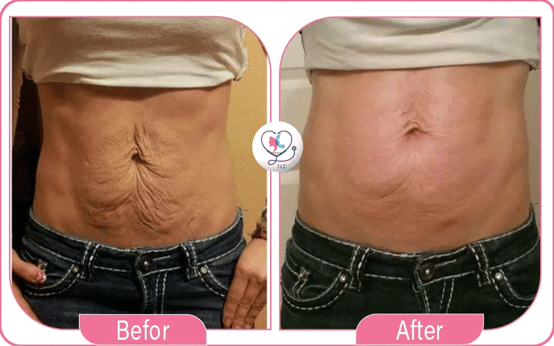 Belly Button Before and After Tummy Tuck