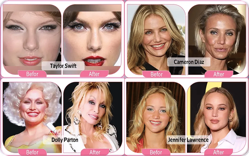 Celebrity Blepharoplasty Before and After