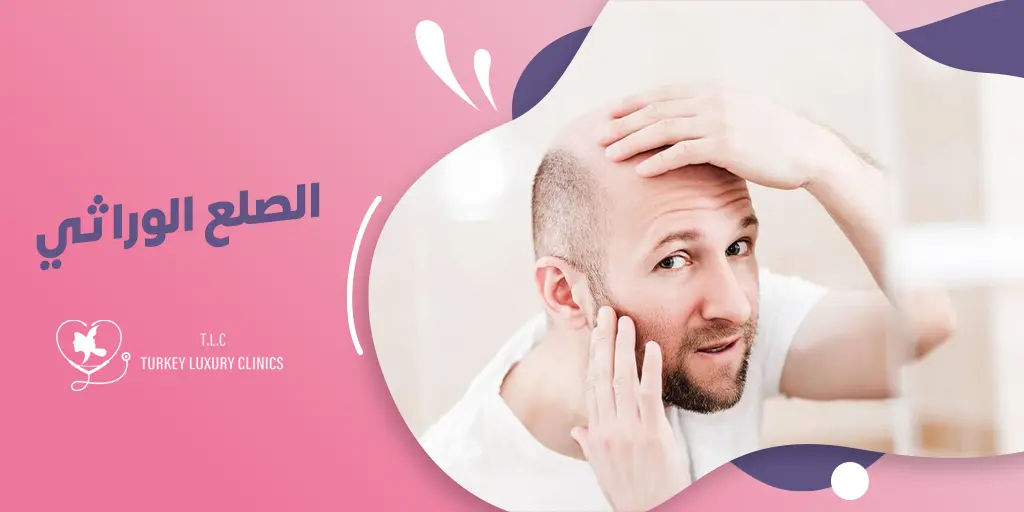 تعرف على علاج الصلع الوراثي في تركيا