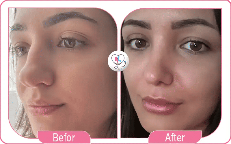 ارتفاع ارنبة الأنف بعد عملية التجميل