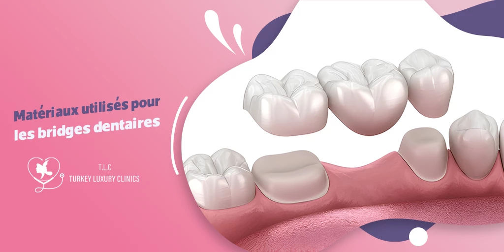 Matériaux utilisés pour les bridges dentaires