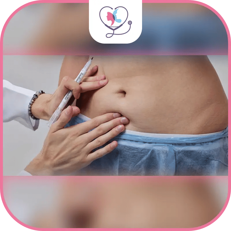 نصائح لممارسة التمارين الرياضية بعد عملية شد البطن