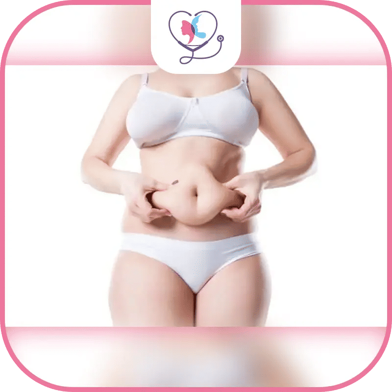 عملية شد البطن بعد تكميم المعدة