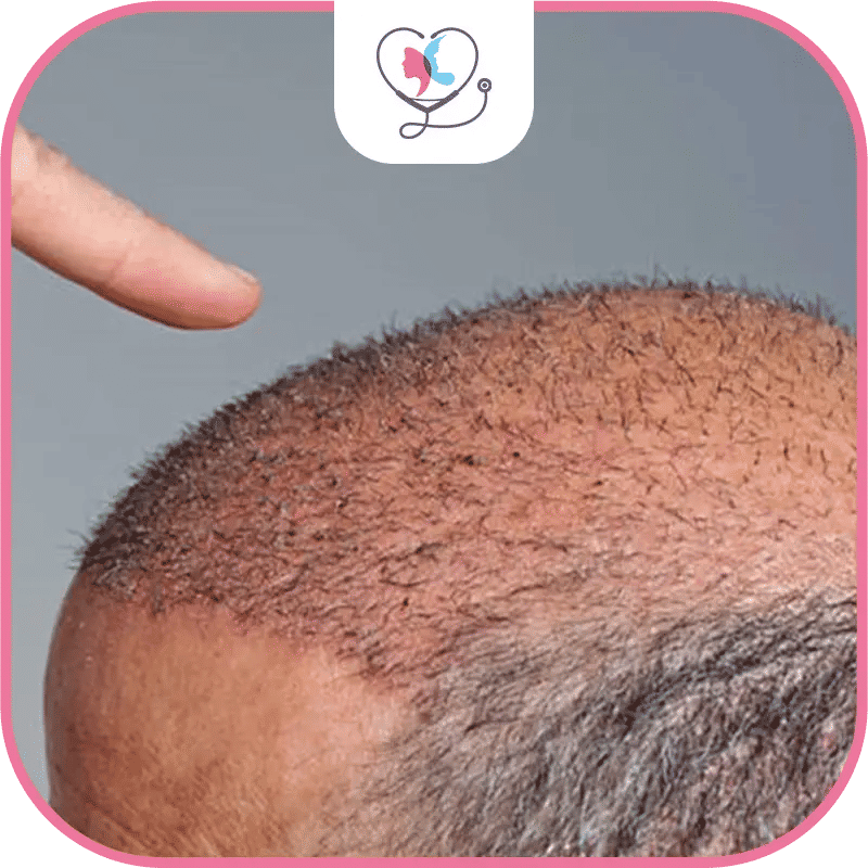 Hair Transplant Density