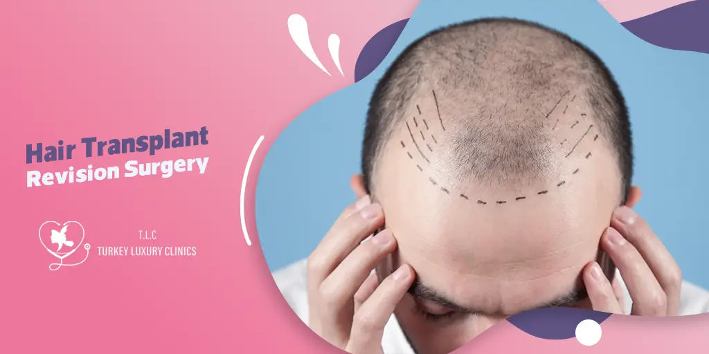 Hair Transplant Revision Surgery
