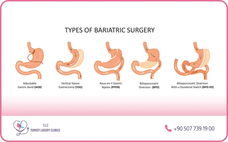 Sleeve, bypass ou anneau gastrique 