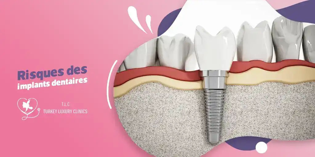 Risques liés à l’implant dentaire