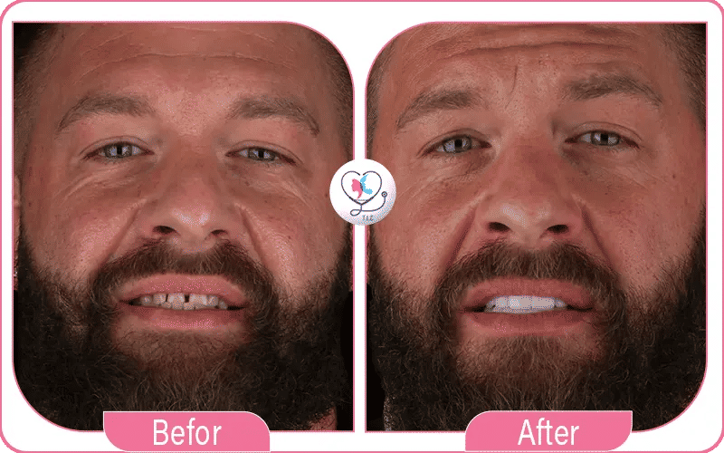 تجربتي مع تبييض الأسنان بالليزر لتصبغات القهوة والتدخين